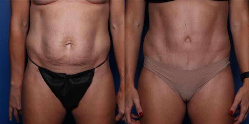 Tummy Tuck (Abdominoplasty) procedure image