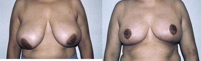 Breast Augmentation procedure image