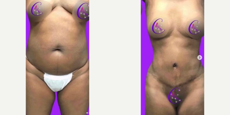 Breast Augmentation procedure image