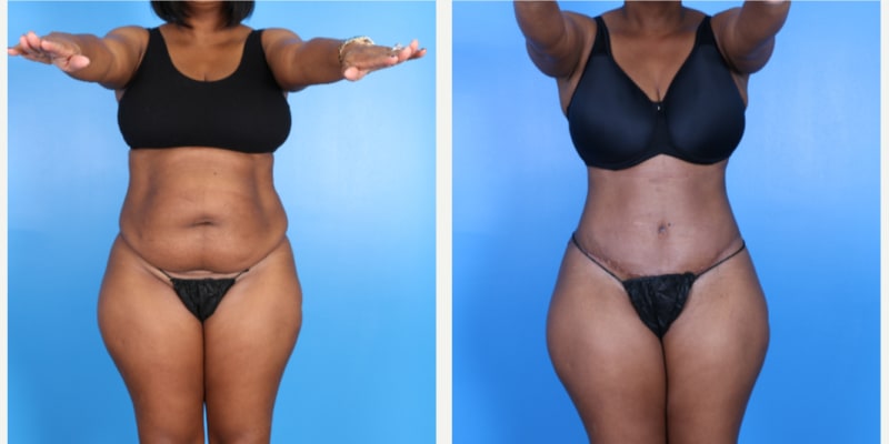 Skin Tightening procedure image