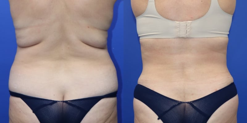 Mommy Makeover procedure image