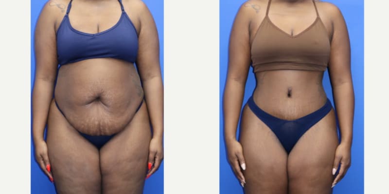 Lipo 360 procedure image