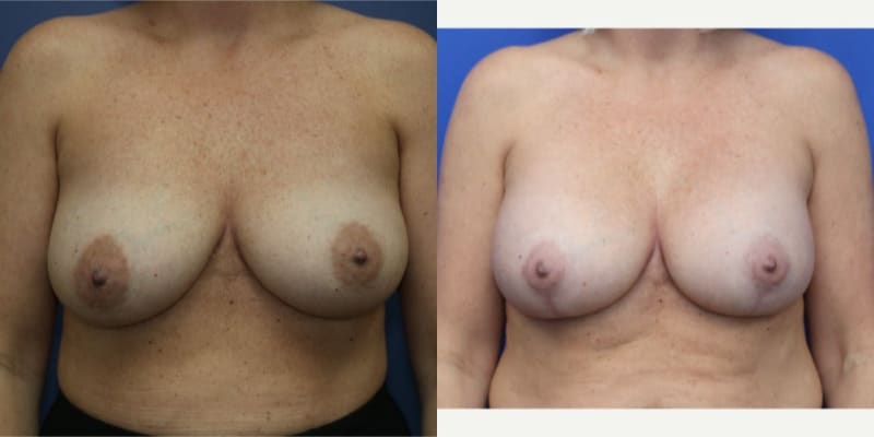 Breast Augmentation procedure image