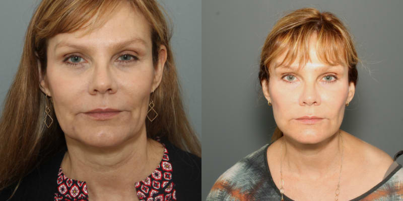 Rhinoplasty (Nose Job) procedure image