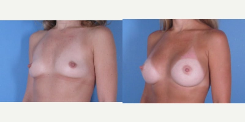 Breast Augmentation procedure image