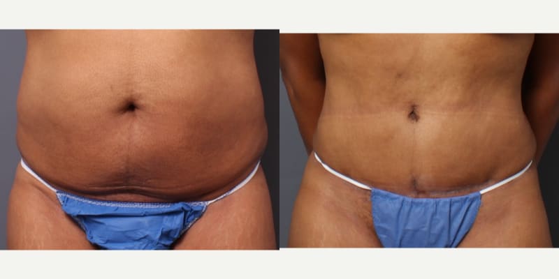 Tummy Tuck (Abdominoplasty) procedure image