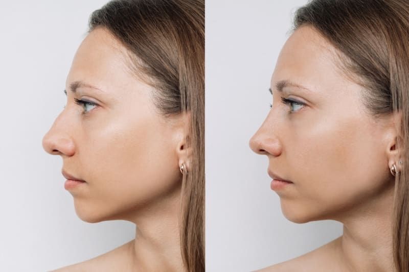Rhinoplasty (Nose Job) procedure image
