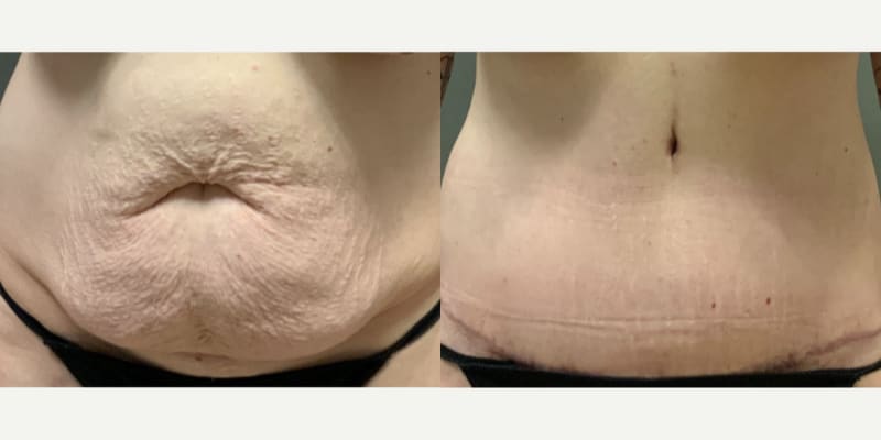 Tummy Tuck (Abdominoplasty) procedure image