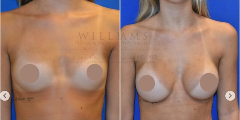 Breast Augmentation procedure image