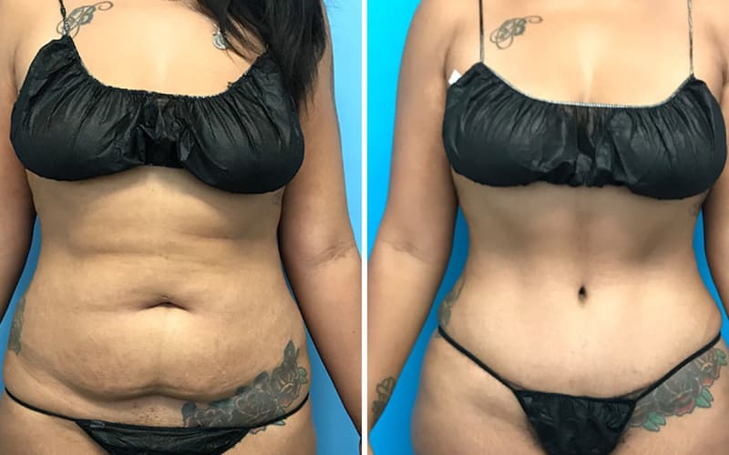 Mommy Makeover procedure image