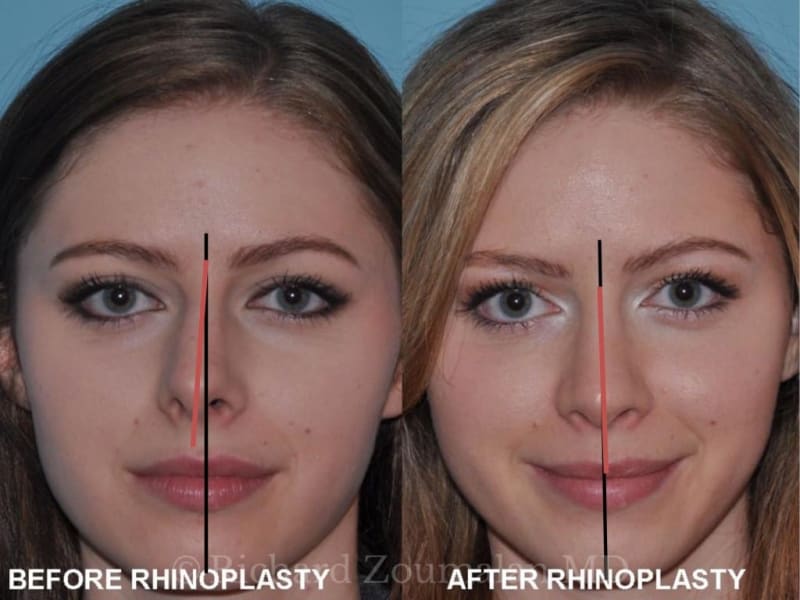 Rhinoplasty (Nose Job) procedure image