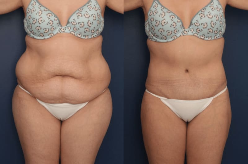 Mommy Makeover procedure image