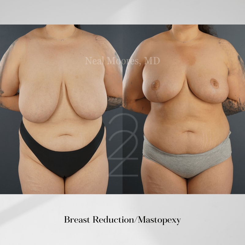 Breast Augmentation procedure image