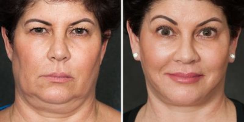 Facelift procedure image