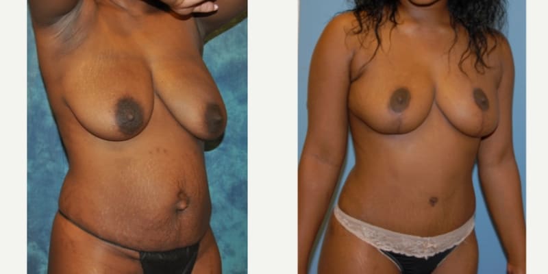 Mommy Makeover procedure image