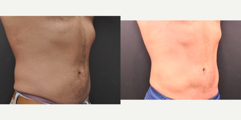Tummy Tuck (Abdominoplasty) procedure image