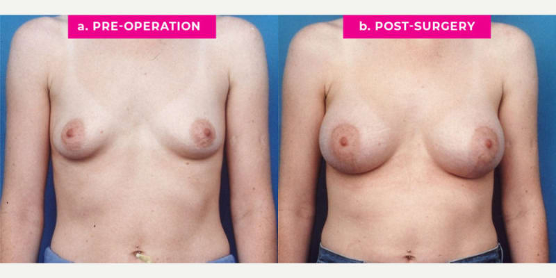 Breast Augmentation procedure image