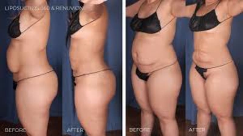 Mommy Makeover procedure image