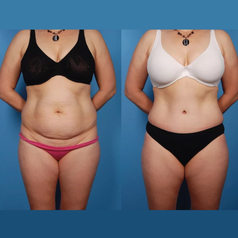 Mommy Makeover procedure image