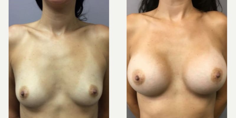 Breast Augmentation procedure image