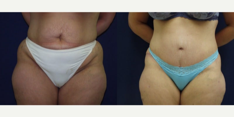 Tummy Tuck (Abdominoplasty) procedure image