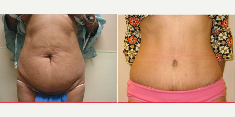 Mommy Makeover procedure image