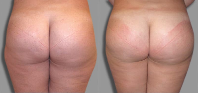 Brazilian Butt Lift (BBL) procedure image