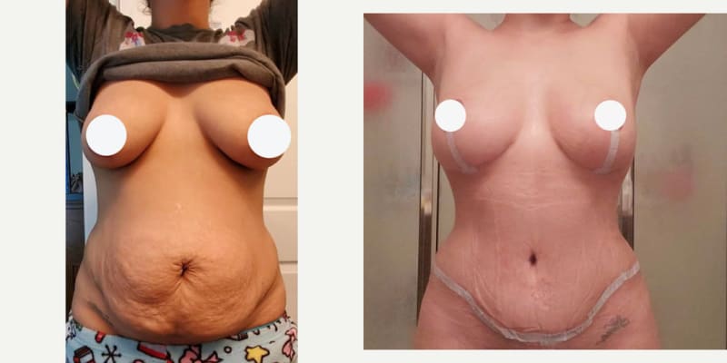 Breast Augmentation procedure image