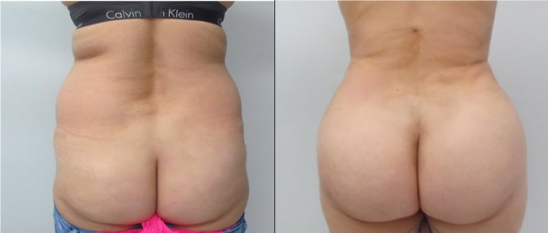 Brazilian Butt Lift (BBL) procedure image