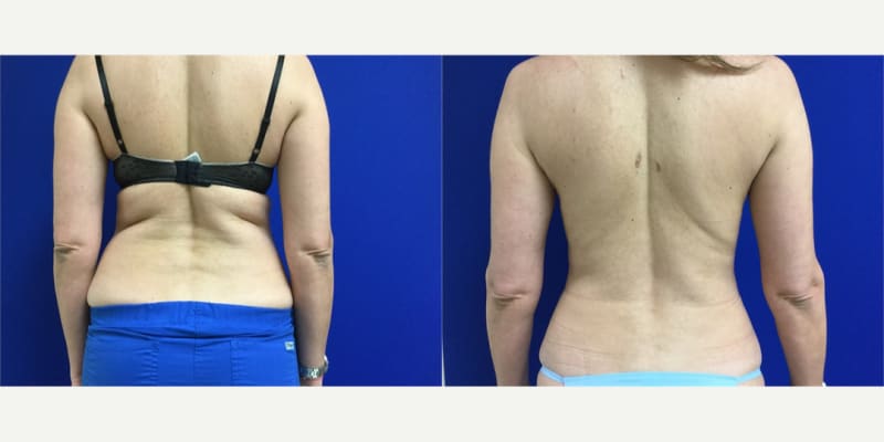 Lipo 360 procedure image