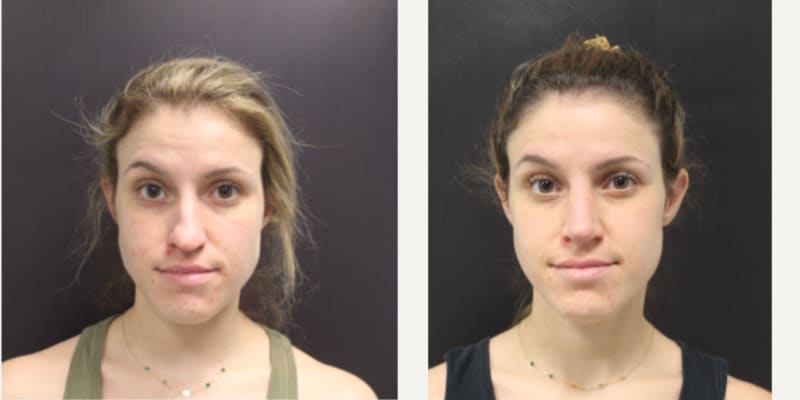 Rhinoplasty (Nose Job) procedure image