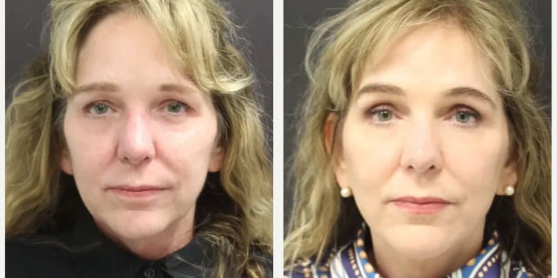 Facelift procedure image