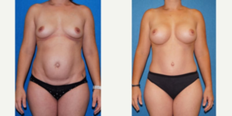 Tummy Tuck (Abdominoplasty) procedure image