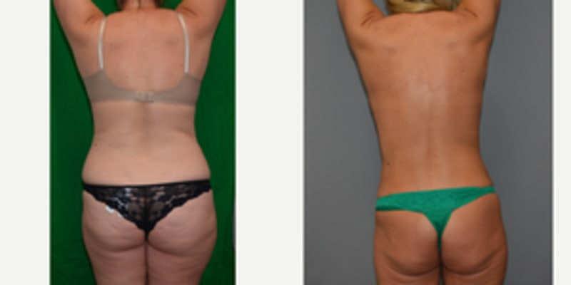 Liposuction procedure image