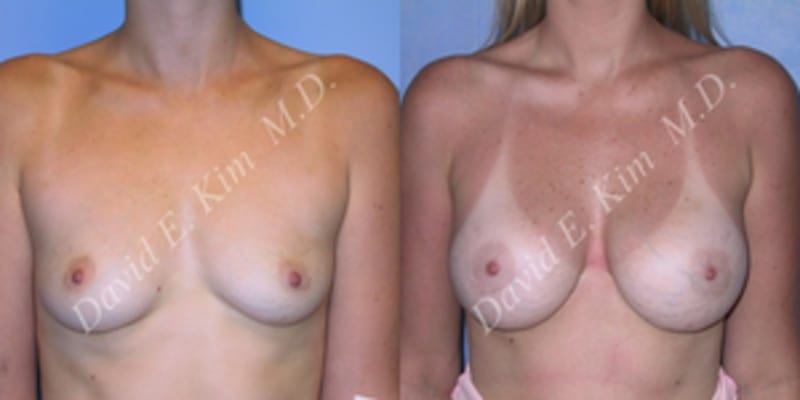 Breast Augmentation procedure image