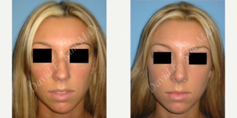 Rhinoplasty (Nose Job) procedure image