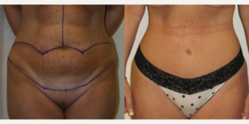 Tummy Tuck (Abdominoplasty) procedure image