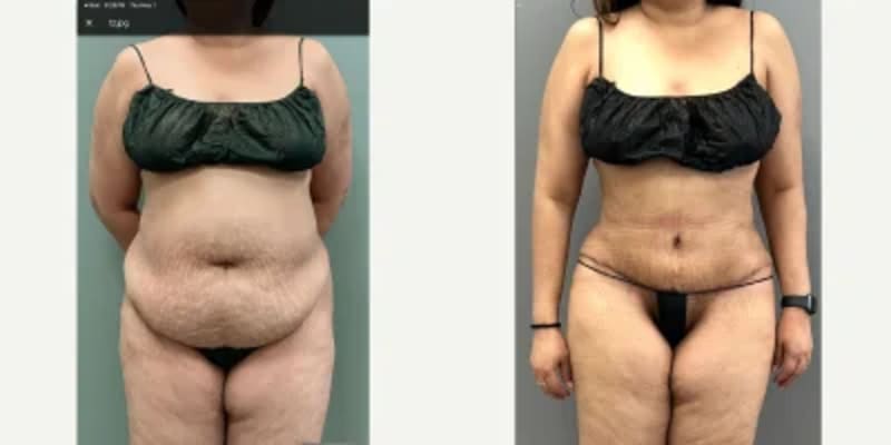 Mommy Makeover procedure image