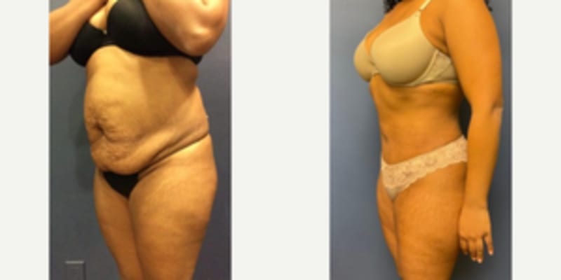 Skin Tightening procedure image