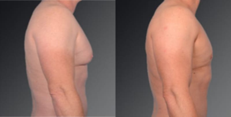 Body Lift procedure image