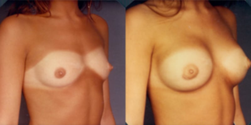 Mommy Makeover procedure image