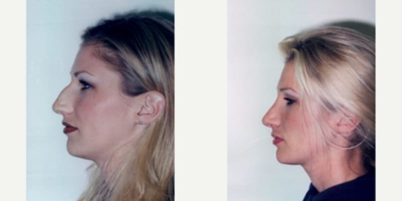 Rhinoplasty (Nose Job) procedure image