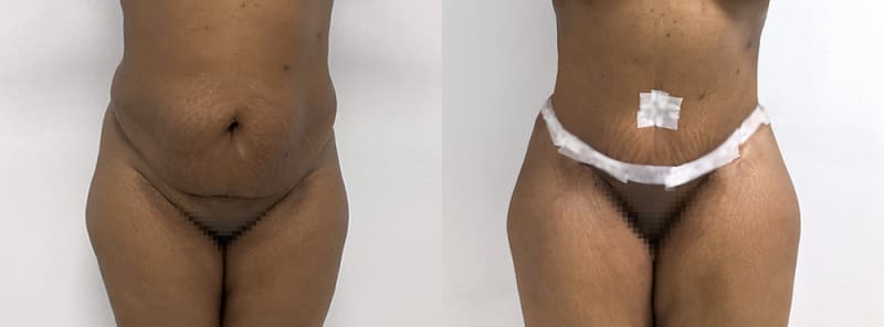 Mommy Makeover procedure image