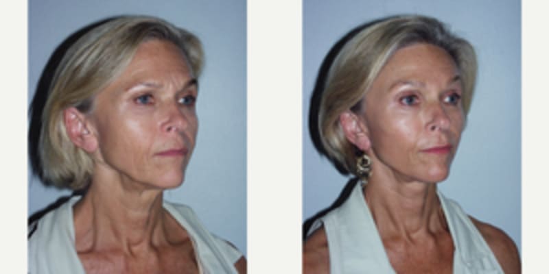 Facelift procedure image
