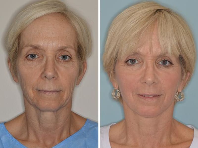 Facelift procedure image