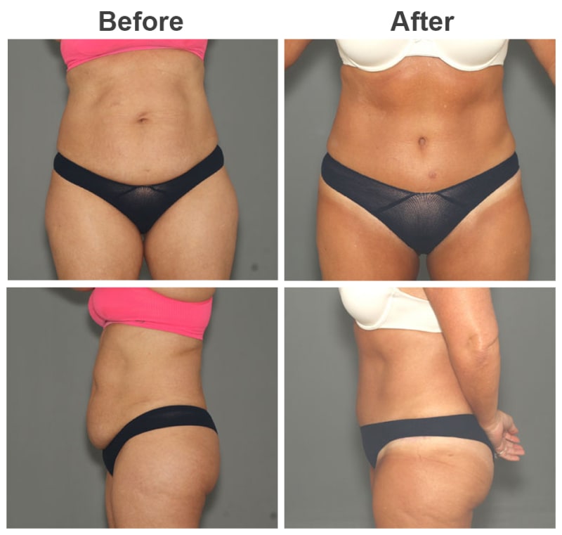 Body Lift procedure image