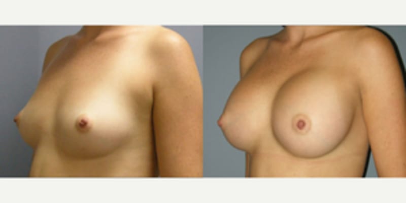 Breast Augmentation procedure image