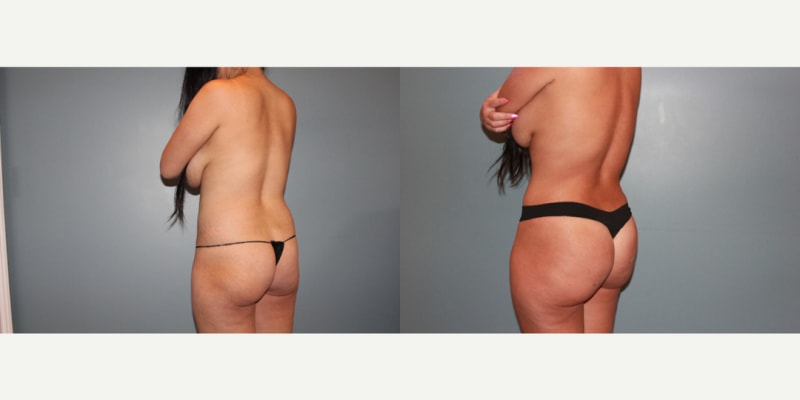 Brazilian Butt Lift (BBL) procedure image
