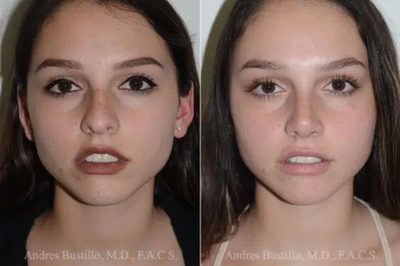 Rhinoplasty (Nose Job) procedure image