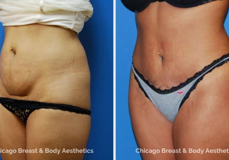 Body Lift procedure image